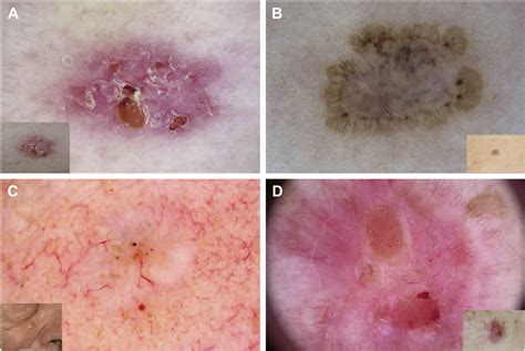 Diagnosis And Treatment Of Basal Cell Carcinoma European Consensus