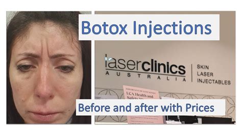 Getting Botox Anti Wrinkle Injections See The Before And After Results