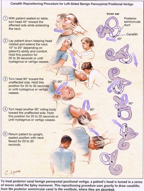 Epley Maneuver Ejercicios De Fisioterapia Maniobra De Epley Y