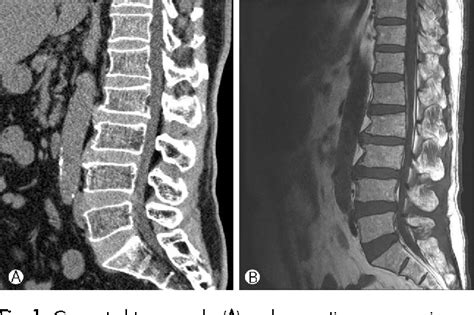 Figure 1 From Continuous Multiple Vertebral Compression Fractures In