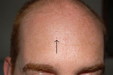 Dilated Pore Of Winer Perri Dermatology