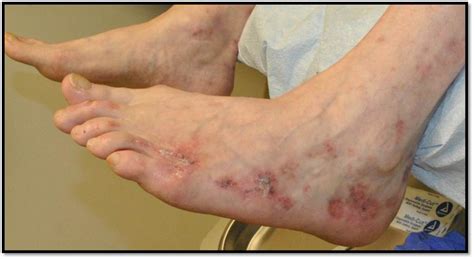 Idiopathic Mixed Small And Medium Vessel Cutaneous Vasculitis A Case