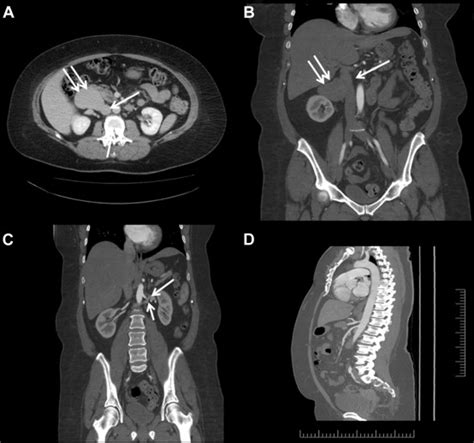 Abdominal Computed Tomography Ct Scan Venous Phase In A Axial And