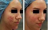 Laser Treatment For Acne Scars African American Images