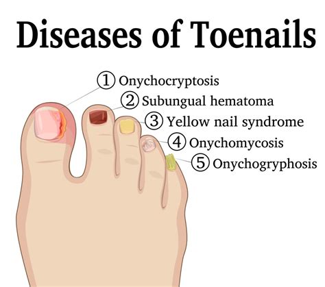 Foot Toe And Toenail Cancer Causes Symptoms And Best Treatment
