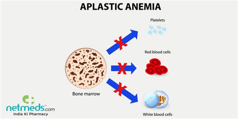 Aplastic Anaemia Causes Symptoms And Treatment