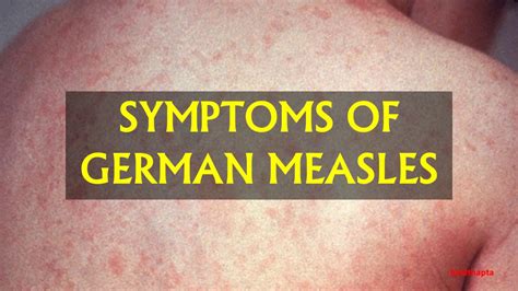 Symptoms Of German Measles Youtube