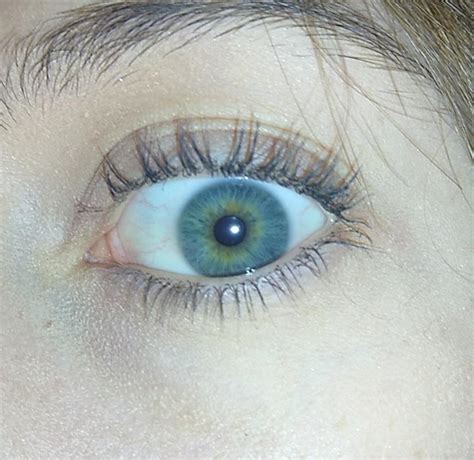 Is This Central Heterochromia I Consider My Eyes Blue But People