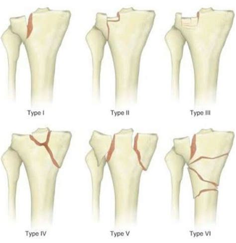 Schatzker Classification For Tibia Plate Fractures Huesos Del Cuerpo