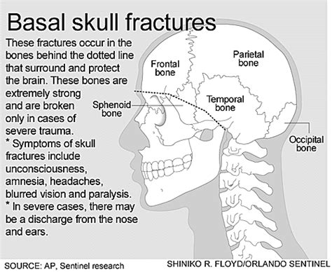 Basal Skull Fracture Orlando Sentinel
