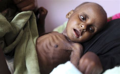 Horrifying Images Of Starving Children Reveal The Ongoing Toll Of Yemen