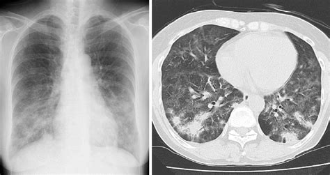 Figure1chest Radiograph And Computed Tomography Scan Showing