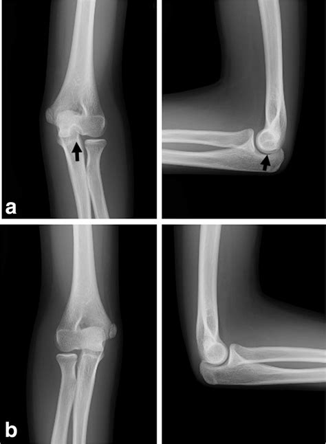 a 14 year old girl with distal defect of the humerus plain radiographs download scientific