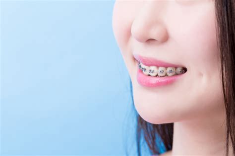 Can Braces Improve The Shape Of Your Face Shinagawa Dental Blog