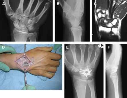 Preiser S Disease Kienbock Disease Arthritis Research