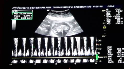 Baby 12 Week Ultrasound And Heartbeat Youtube