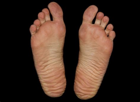 The Causes Of Dry Skin On Your Feet And How To Treat It Chiropractor