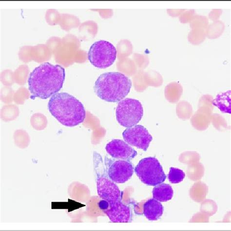 The Peripheral Blood Smear Reveals Marked Leukocytosis With Predominant