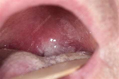 Infected Tonsil Stock Image C0197727 Science Photo Library