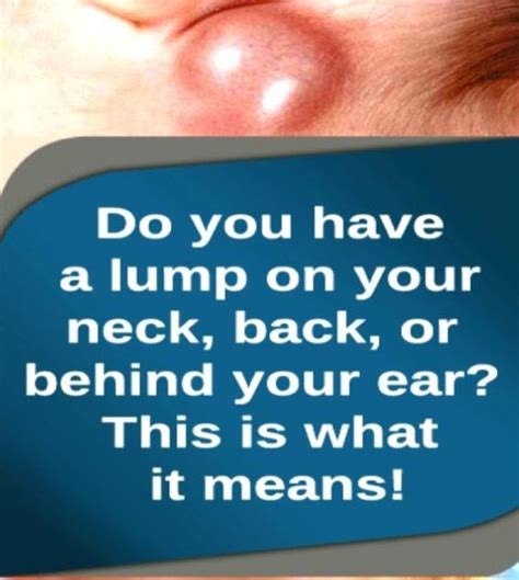 Do You Have A Lump On Your Neckbackor Behind Your Ear This Is What It