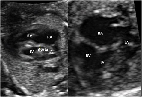 Prenatal Fetal Echocardiography Showing A Four Chamber View Of The