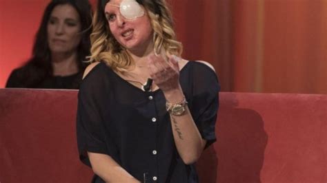 [fotos] Modelo Italiana Atacada Con ácido Decidió Mostrar Cómo Le Quedó La Cara Cooperativa Cl
