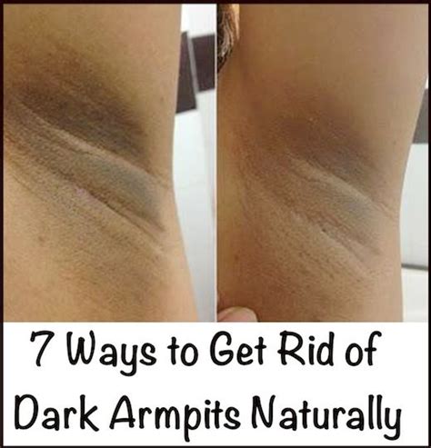 7 Ways To Get Rid Of Dark Armpits Naturally Positivemed Dark