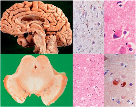 Dementia With Lewy Bodies Diffuse Brain Atrophy Upper Left