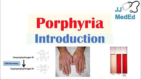 Introduction To Porphyria Porphyria Cutanea Tarda Vs Acute