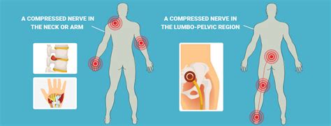 Pinched Nerve Pelvic Pain