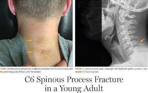 Figure 2 From C6 Spinous Process Fracture In A Young Adult Semantic