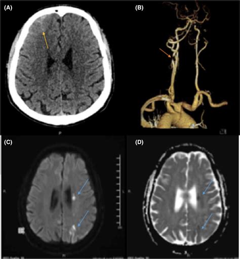 Acute Ischemic Stroke And Convexity Subarachnoid Hemorrhage In Large