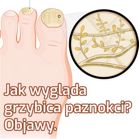 Jak Wygląda Grzybica Paznokci Objawy Poradnik