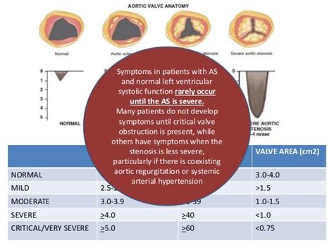 Natural History And Treatment Of Aortic Stenosis