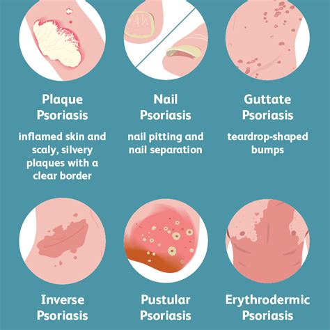Psoriasis Chronic Skin Disease Seattle Dermatology