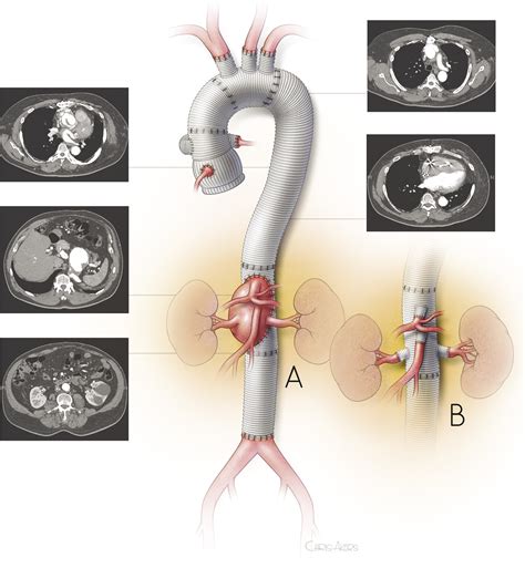 References In Redo Thoracoabdominal Aortic Aneurysm Repair A Single