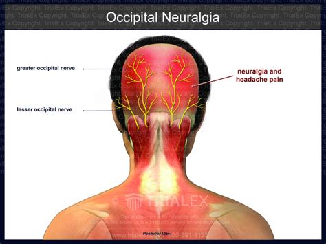 Occipital Neuralgia Trial Exhibits Inc