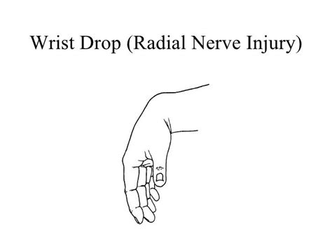 Wrist Drop Radial Nerve Injury Radial Nerve Nerve Kinesiology