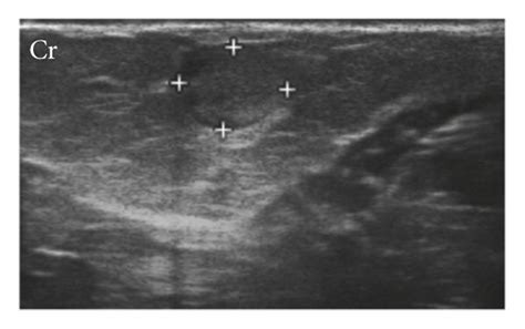 B Mode Ultrasound Of Lymph Nodes In A Two Year Old Cat With Abnormal
