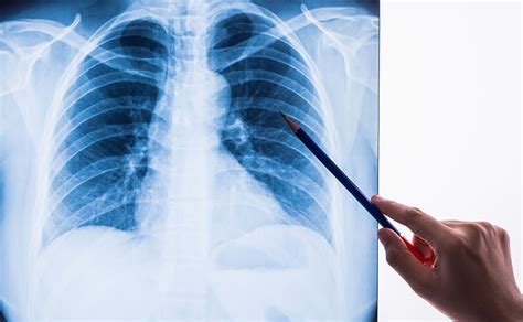 Your healthcare provider will then review the images and radiologist's report so they can. Chest X-rays May Provide New Health Risk Clues ...