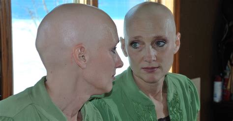 Radiation treatment and hair loss. All you need to know about cancer treatment induced hair ...