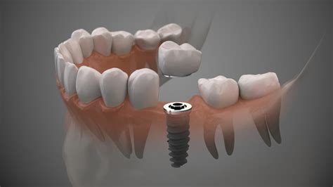 Know The Pros And Cons Of Tooth Replacement Options Dentist