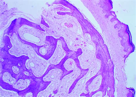 Histological Section Of Bony Tissue Consisted Of Mature Trabecular
