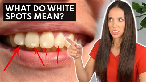 What Are White Spots On Teeth Telling You Dental Clinic