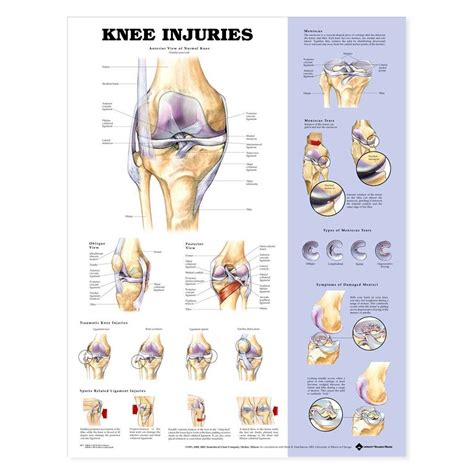 Details About The Knee Injuries Anatomical Charts 20x26 Knee Injury
