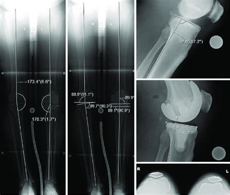 16 Limb And Knee Radiographs Post Operative Long Leg Radiographs With