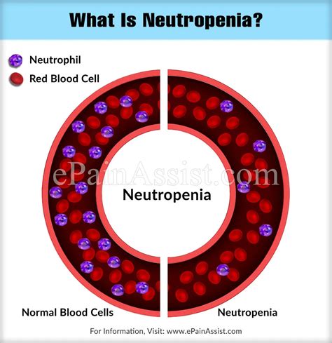 What Is Neutropenia And Neutropenic Dietneutropenic Care And Symptom