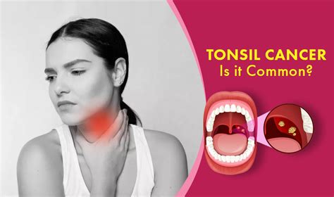 Tonsil Cancer Is It Common How Common Is Tonsil Cancer Cancer