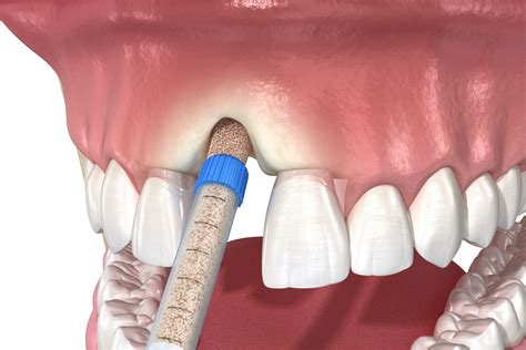 Gum Bone Spur Pictures