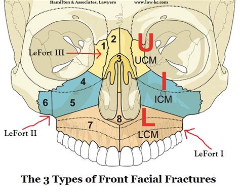 It's released under a creative commons. Broken Bone Lawyers: Kansas City Skull Fracture Law Firm